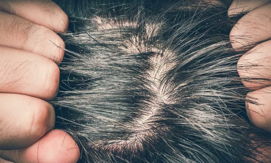 Gist op hoofdhuid: hoe BRUNS natuurlijke shampoo helpt bij verlichting