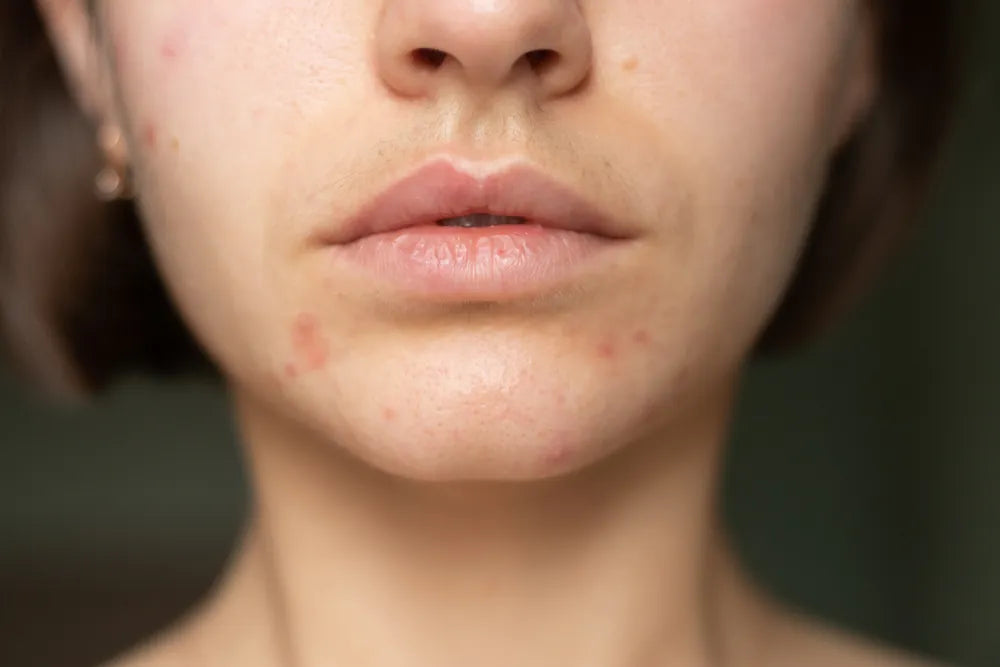 Acne en puistjes bestrijden zonder huid te beschadigen