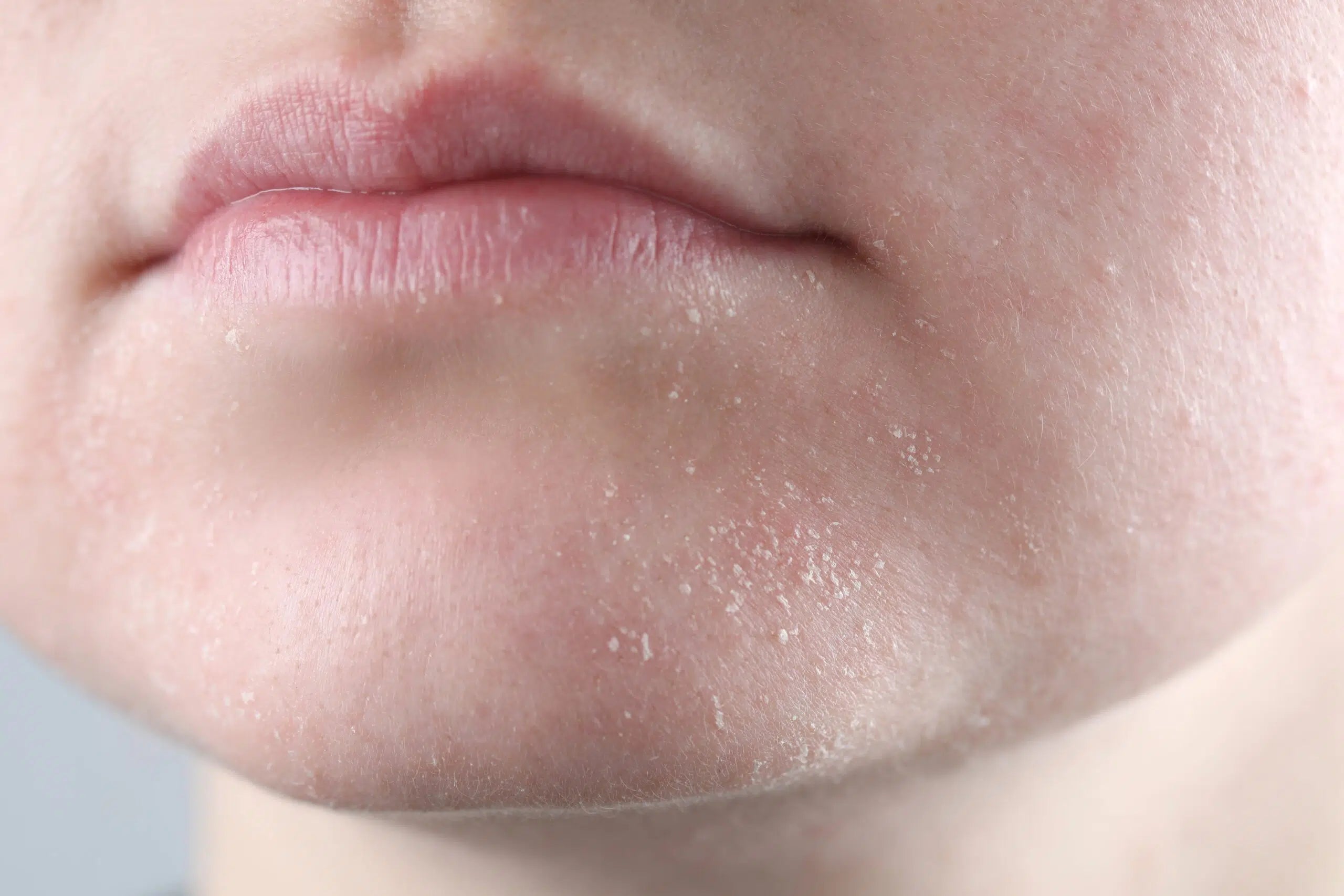 Droge en doffe huid hydrateren
