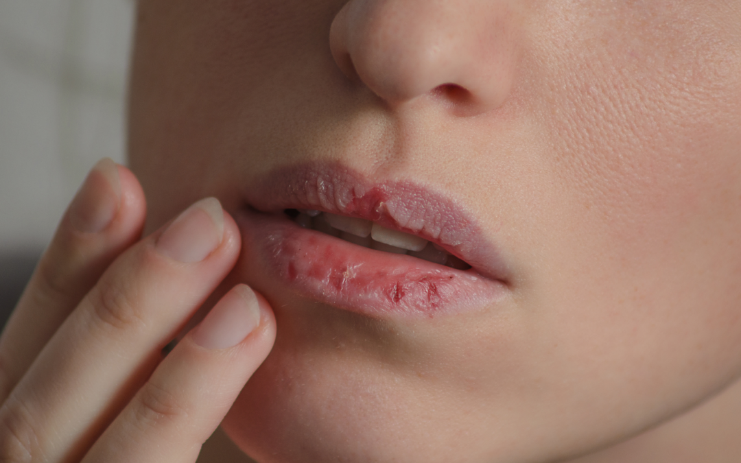 Droge en gebarsten lippen verzorgen