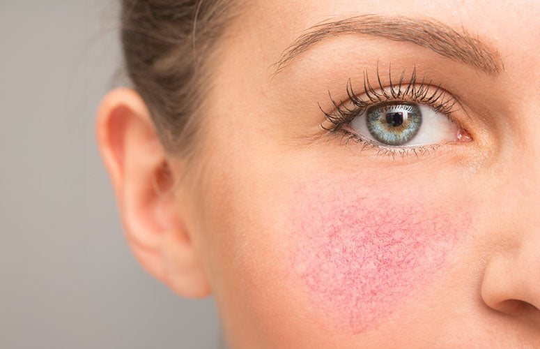 Roodheid en couperose zichtbaar verminderen